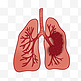 肺癌支气管肺炎