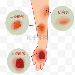 起泡酒瓶塞图片_起泡水泡烫伤分级