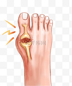 关节手摆件图片_脚关节痛风疼痛