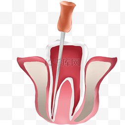 牙科元素图片_牙科根管治疗