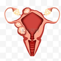 子宫堵塞图片_癌细泡卵巢癌