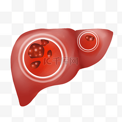 肝癌细胞图片_肝癌肝病