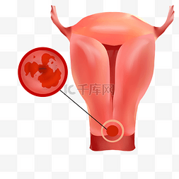 受损的子宫壁图片_身体器官宫颈癌