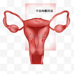 子宫内膜异位图片_妇科病子宫内膜异位症