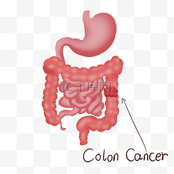 小肠图片_人体内脏结肠癌