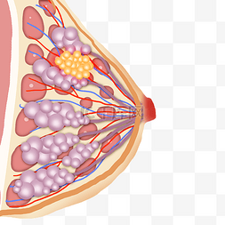 肿瘤侵袭图片_女性乳腺肿瘤