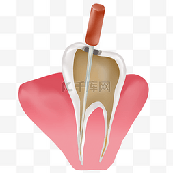 根管治疗图片_牙齿根管治疗