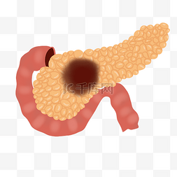 胰腺炎图片_胰腺癌人体器官