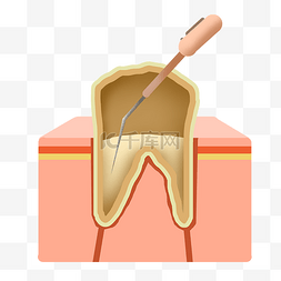 根管治疗图片_医疗牙齿根管治疗