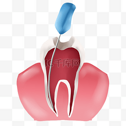 牙科元素图片_口腔科根管治疗