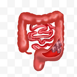 大肠图片_结肠癌癌症病症