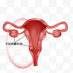 大鼠子宫图片_子宫妇科病子宫内膜异位症