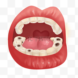 口腔牙齿虫牙