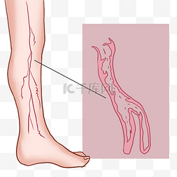症状性颈动脉狭窄图片_腿部生病静脉曲张