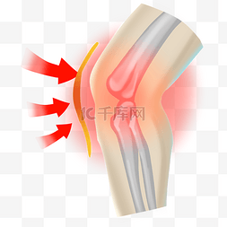膝盖骨骼图片_膝盖痛风湿疼痛