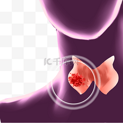 癌症痛处图片_医疗甲状腺癌癌症