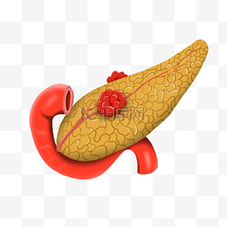 医学解刨胰腺癌肿瘤