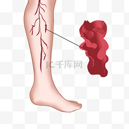 动脉硬化指数图片_腿部静脉曲张