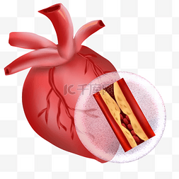 心脑血管预防图片_心梗冠心病心脏