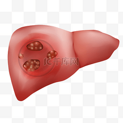 病毒性肝炎图片_肝脏肝癌癌症