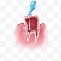 根管治疗图片_医疗根管治疗