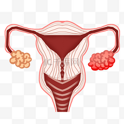 女性健康学图片_女性健康卵巢癌