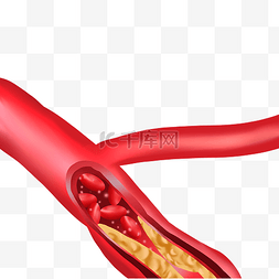 周围血管图片_血栓堵塞血管