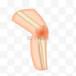 风湿骨关节图片_膝关节关节痛