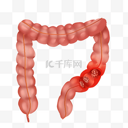 脏空气肠道图片_医疗癌症直肠癌