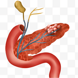 医学解刨胰腺癌肿瘤