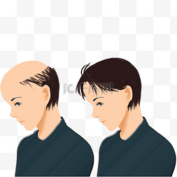 脱发级别图片_男士短发植发对比图
