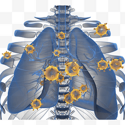 x光片图片_黄色冠状病毒性肺炎立体3d元素