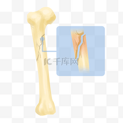 尖锐的骨骼图片_骨头骨折骨裂