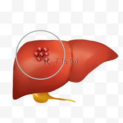肝脏肝包膜图图片_肝病肝癌癌细胞