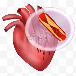 心脏劳累图片_心肌梗死心血管