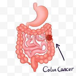 大肠图片_结肠癌病灶