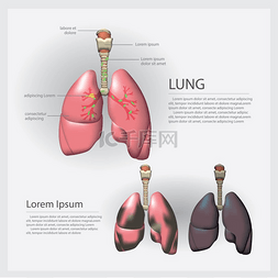 肺部细节和肺癌症载体插图