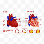 人体器官心脏解剖图及冠状动脉粥样硬化发展