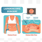 腹腔镜手术医疗保健手术过程, 解剖剖面矢量图解图.