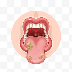 鳄鱼的嘴巴图片_口腔溃疡医学粘膜炎症