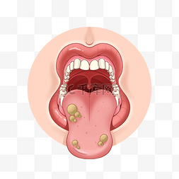 卡通口腔溃疡图片_口腔溃疡医学粘膜炎症