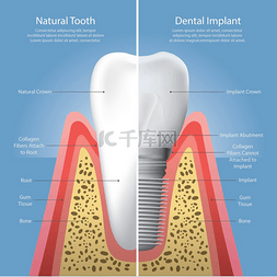 人类的牙齿和牙种植体矢量图
