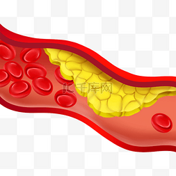 人体血管图图片_血管堵塞红色血管