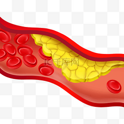 血管堵塞红色血管