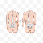 脊柱侧弯矫正
