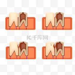 虫牙图片_立体蛀牙形成过程