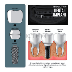 信息图表牙种植体结构信息海报与