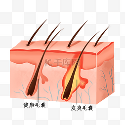 皮肤毛囊问题立体剖面图