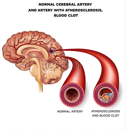 动脉硬化指数图片_正常的脑动脉和动脉的血凝块