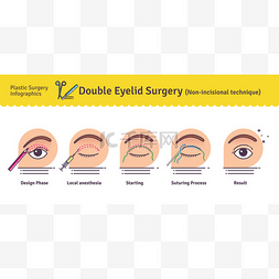手术切口图片_矢量插图镶有双眼皮手术。非切口